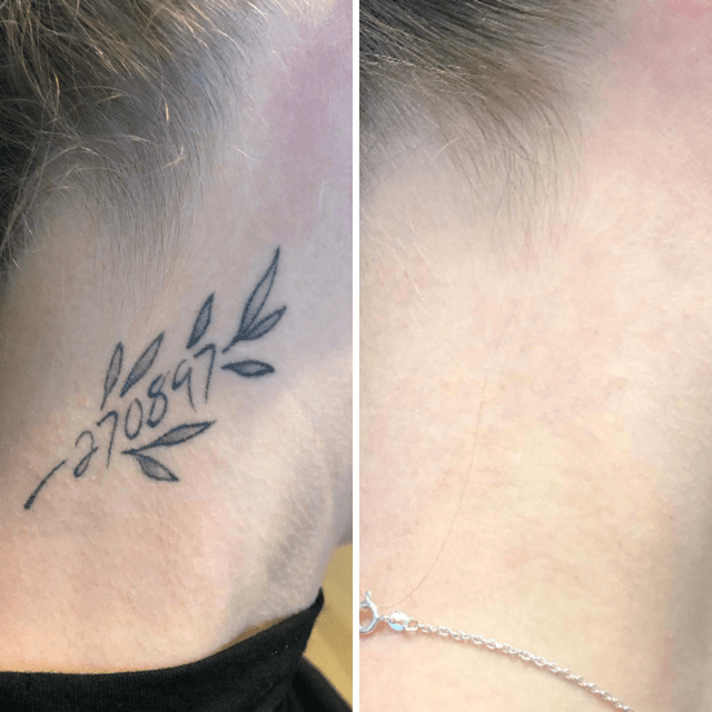Удаление тату лазером - особенности процедуры