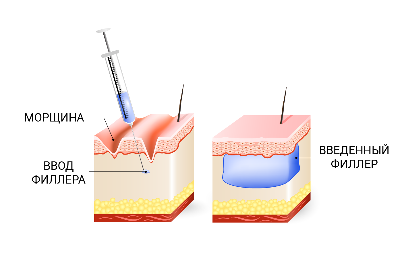 Как работает филлер. Схема Введение гиалуроновой кислоты. Глубина введения филлера. Филлеры схема.