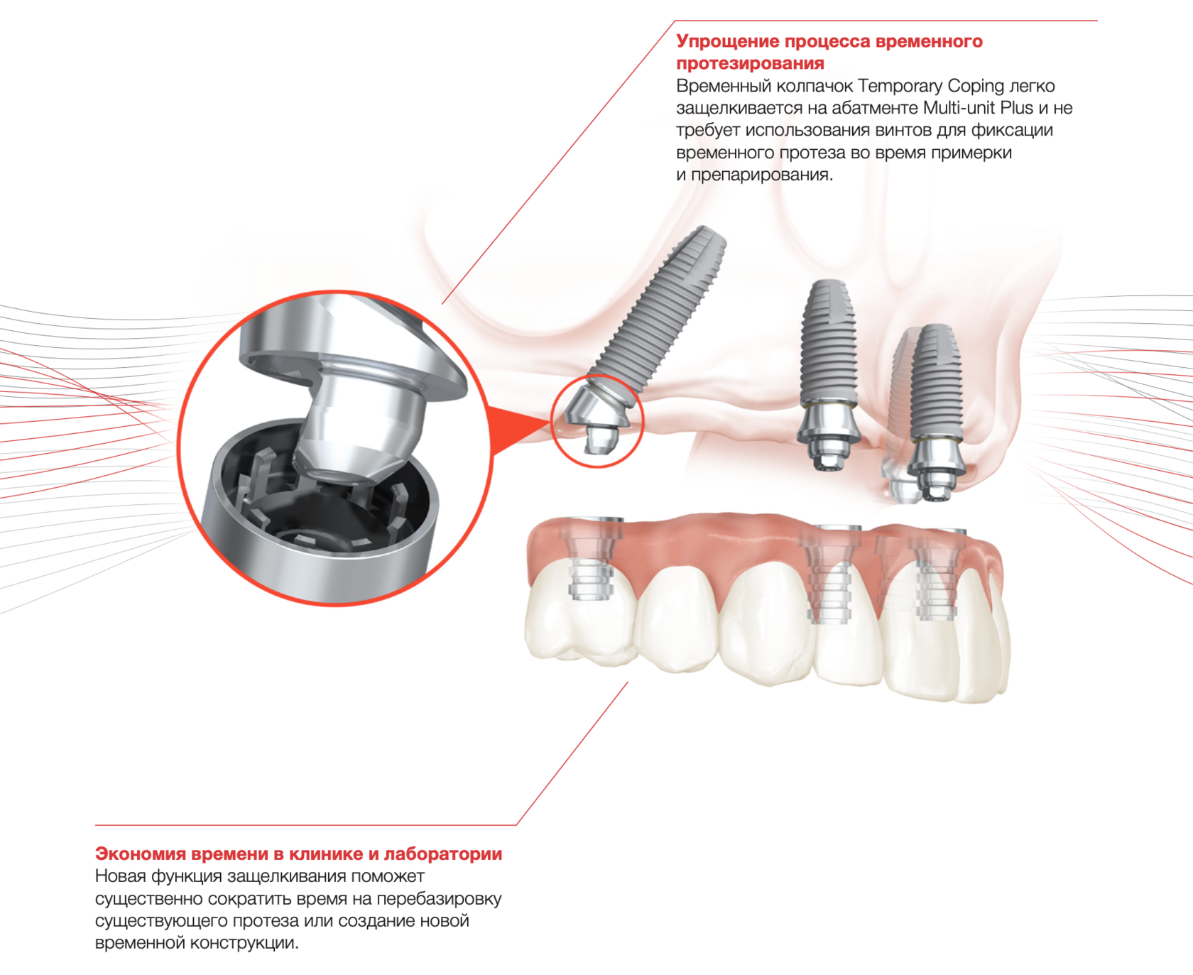 Импланты под углом. Multi Unit Abutment Nobel Plus. Мульти Юнит абатмент. Импланты Nobel Biocare. Мультиюнит абатмент Нобель.