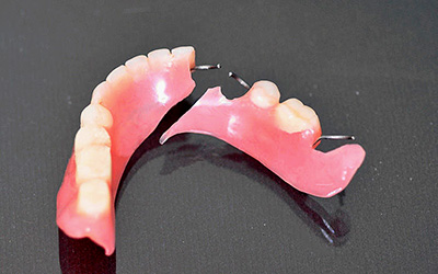 Косметический протез зубов | Стоматологическая клиника Культура