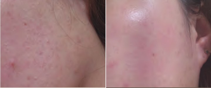 Чувствительная кожа до и после крема PLONTE