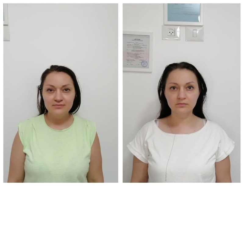 Фейспластика