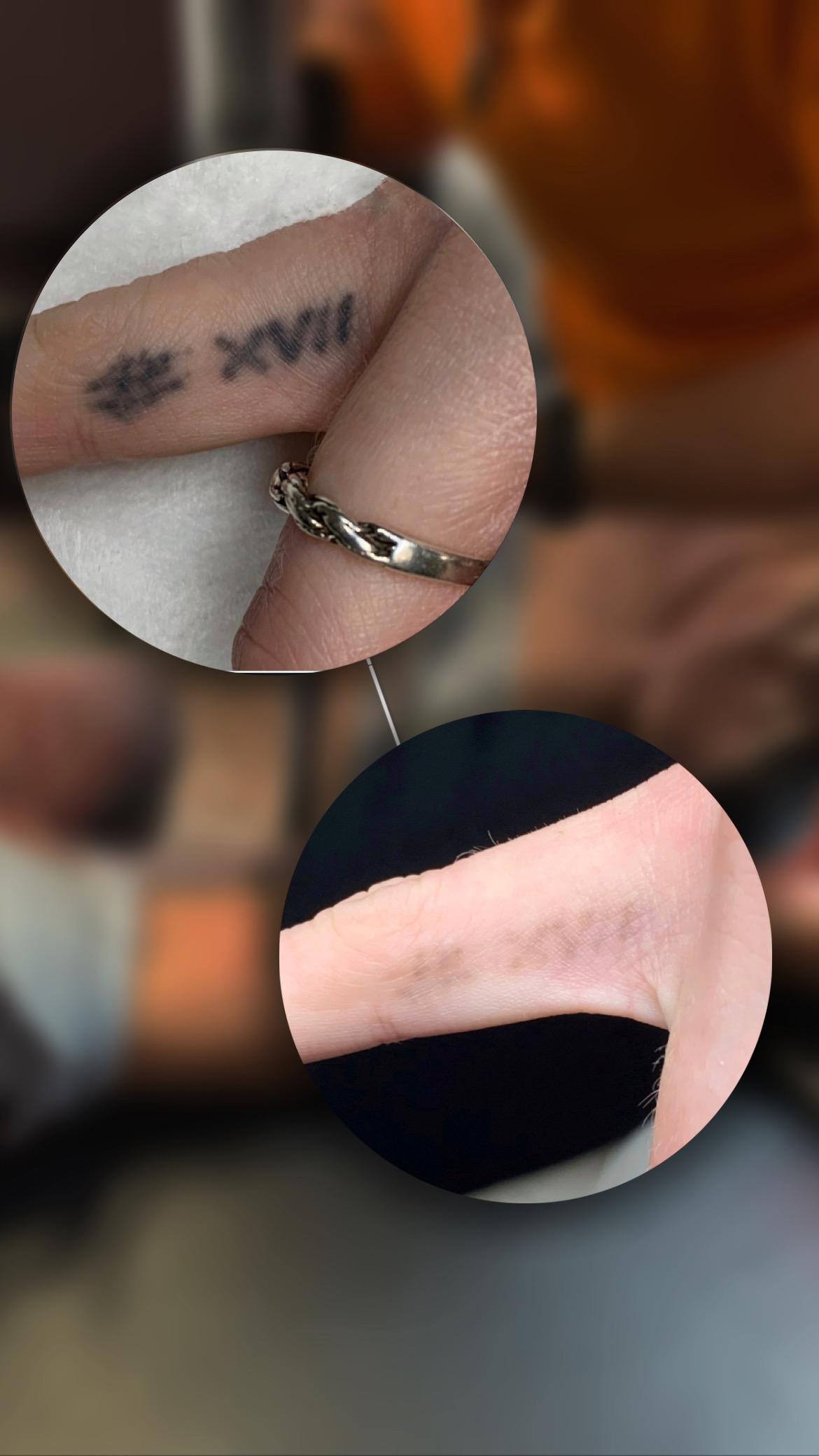 Лазерное удаление татуировок в Ростове-на-Дону