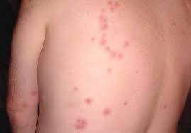 Укусы постельных клопов