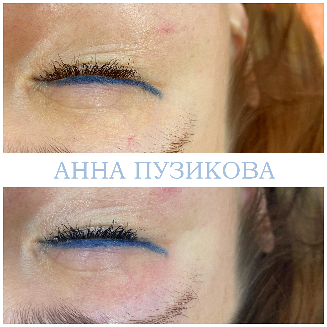 Результат удаления сосудистых звёздочек и купероза на лице с помощью фототерапии ClearLight IPL — врач-косметолог Пузикова Анна Анатольевна, Санкт-Петербург