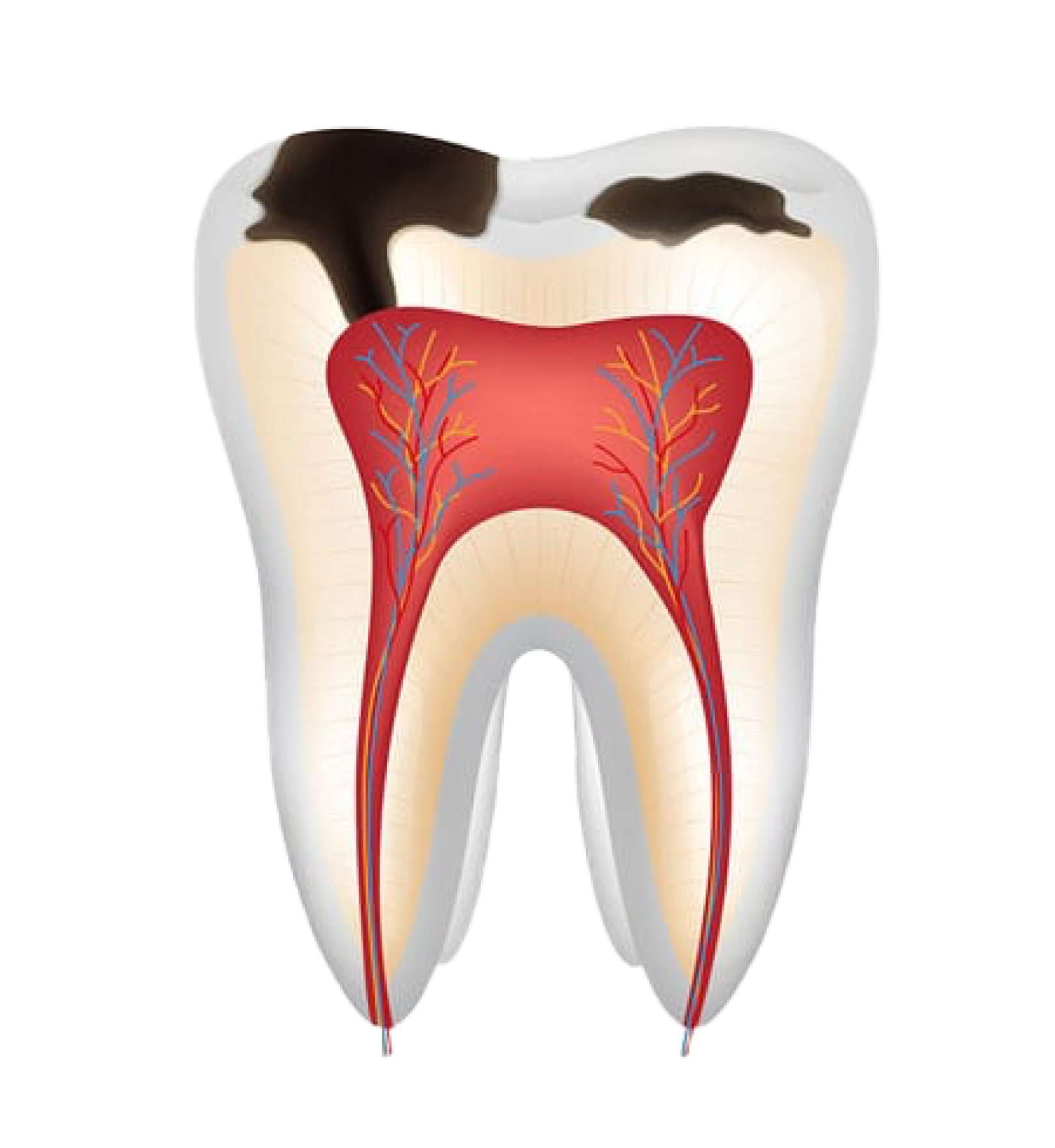 Лечение кариеса и каналов | ABC Clinic