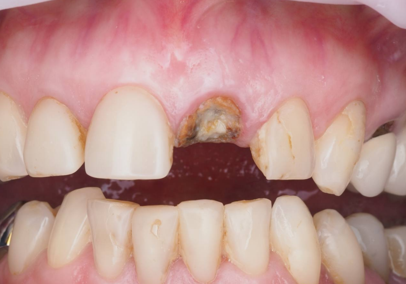 Одномоментная имплантация центрального резца