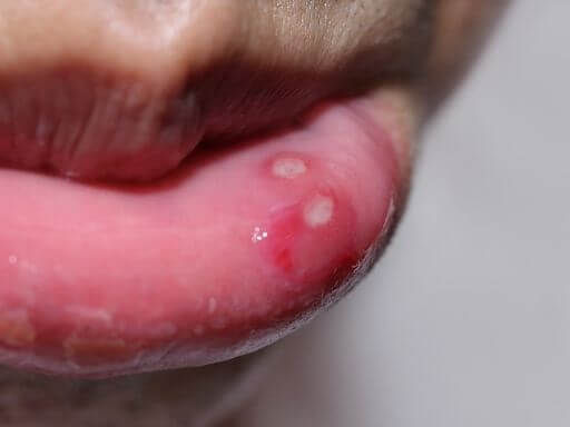 Стоматит на губе у взрослого