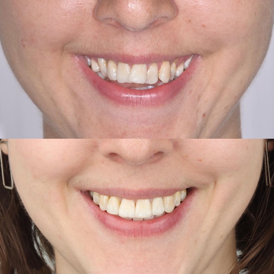 Narrow Arches With Anterior Open Bite and Occlusal Wear