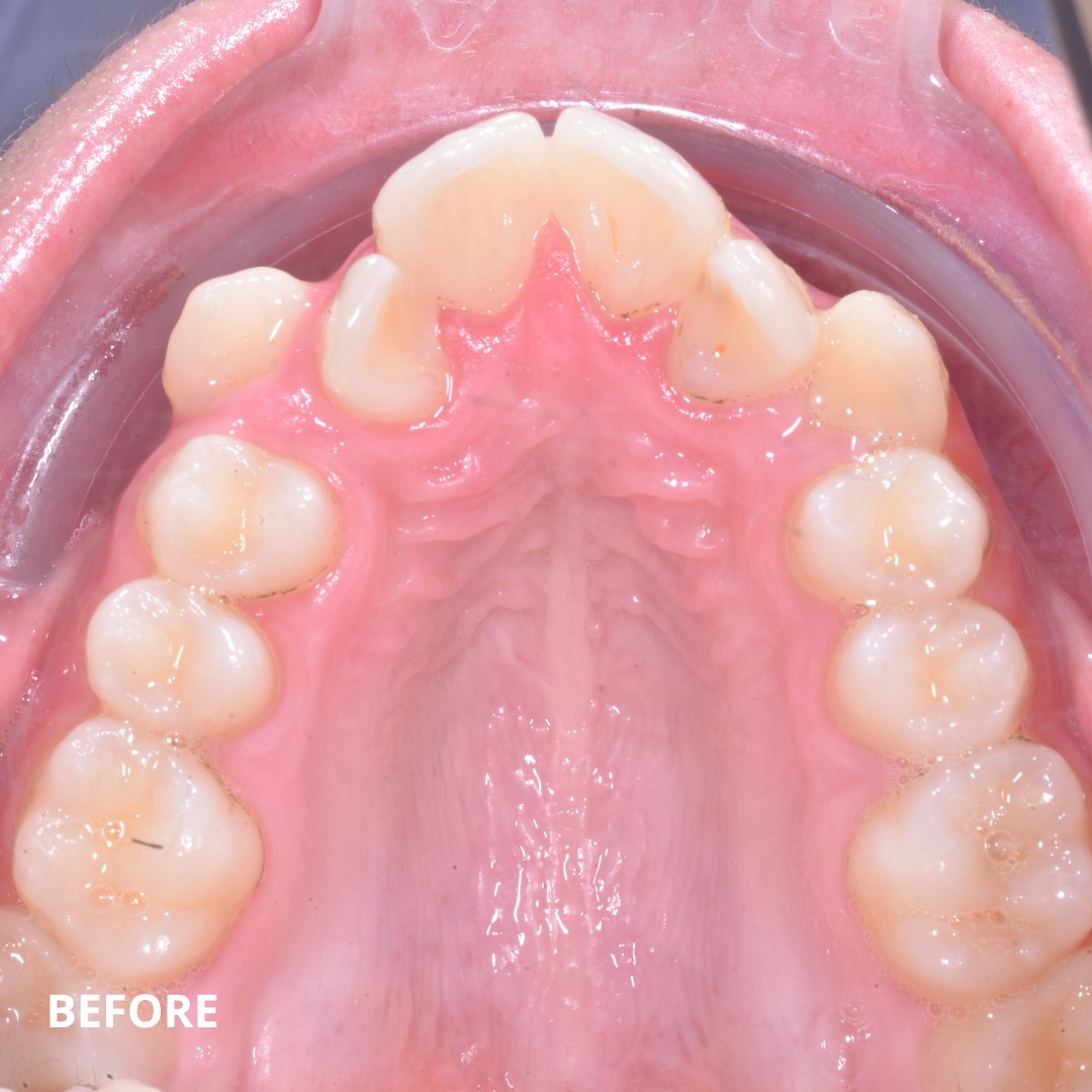 Mid-treatment stage showing MARPE-driven skeletal expansion and bracket alignment — photo 2 of 3
