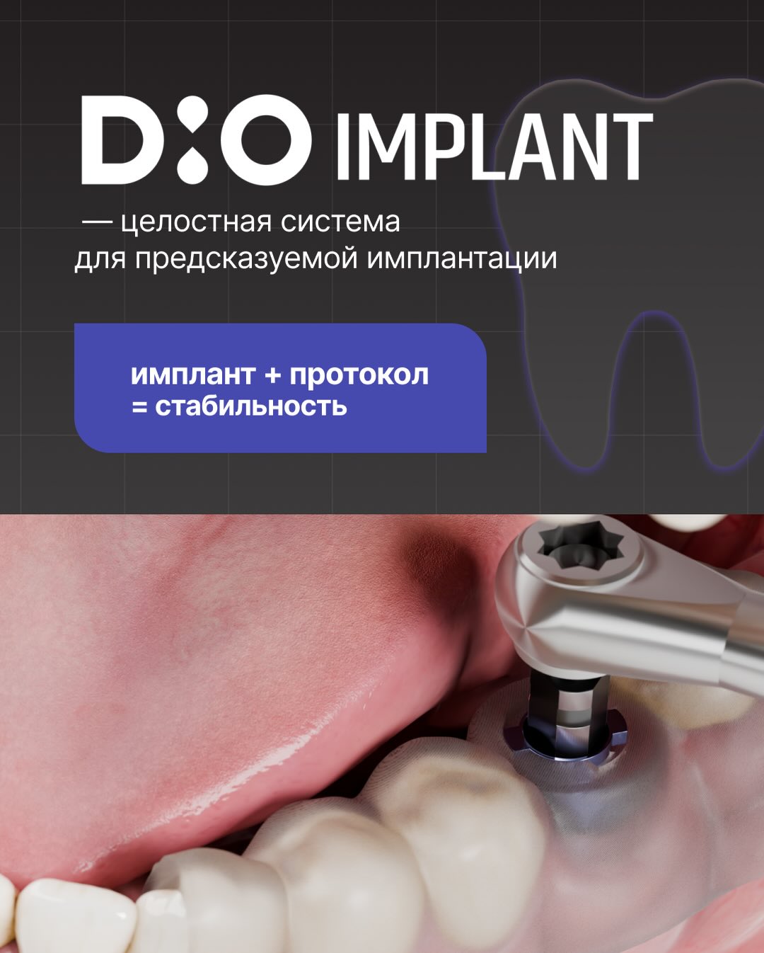 DIO Implant