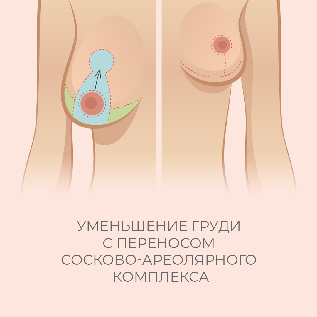 уменьшение груди у женщин причины фото 48
