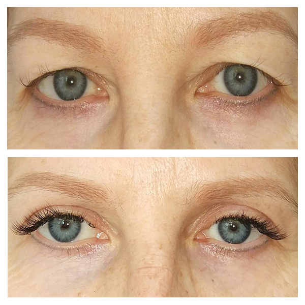 Эстетическая блефаропластика