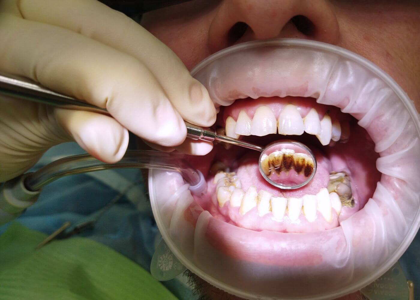 Профессиональная чистка зубов в Перми - Цены на профилактическую ...