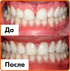 Установка имплантов в Дербенте. Имплантация при отсутствии одного зуба.