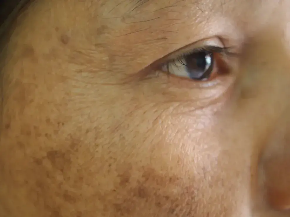 пигментация кожи