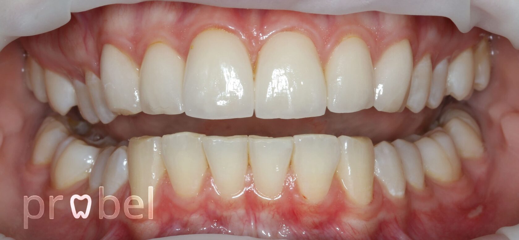 Этап после контурирования десны для выравнивания линии улыбки