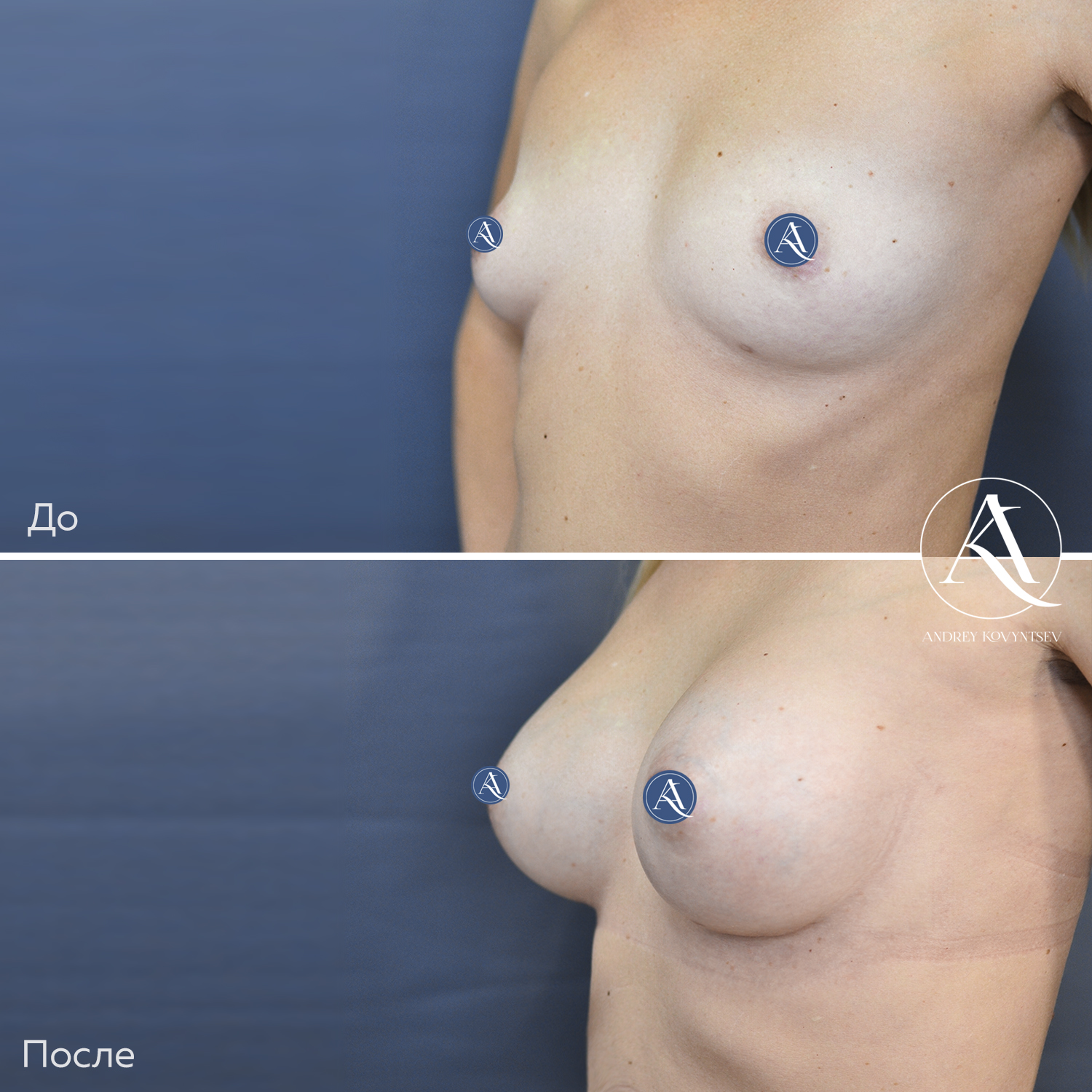 увеличивается грудь у женщин фото 5