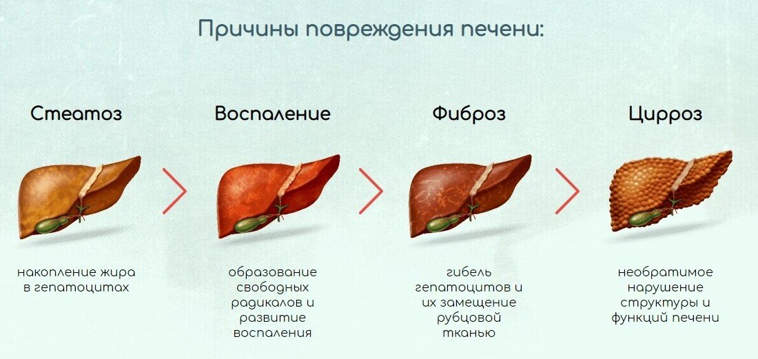 Что это печень однородная. Печень в норме. Размеры печени. Цирроз печени стадии развития. Что это печень однородная.