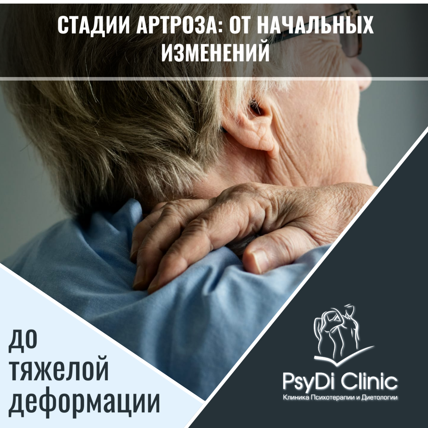 Стадии артроза: от начальных изменений до тяжелой деформации ��