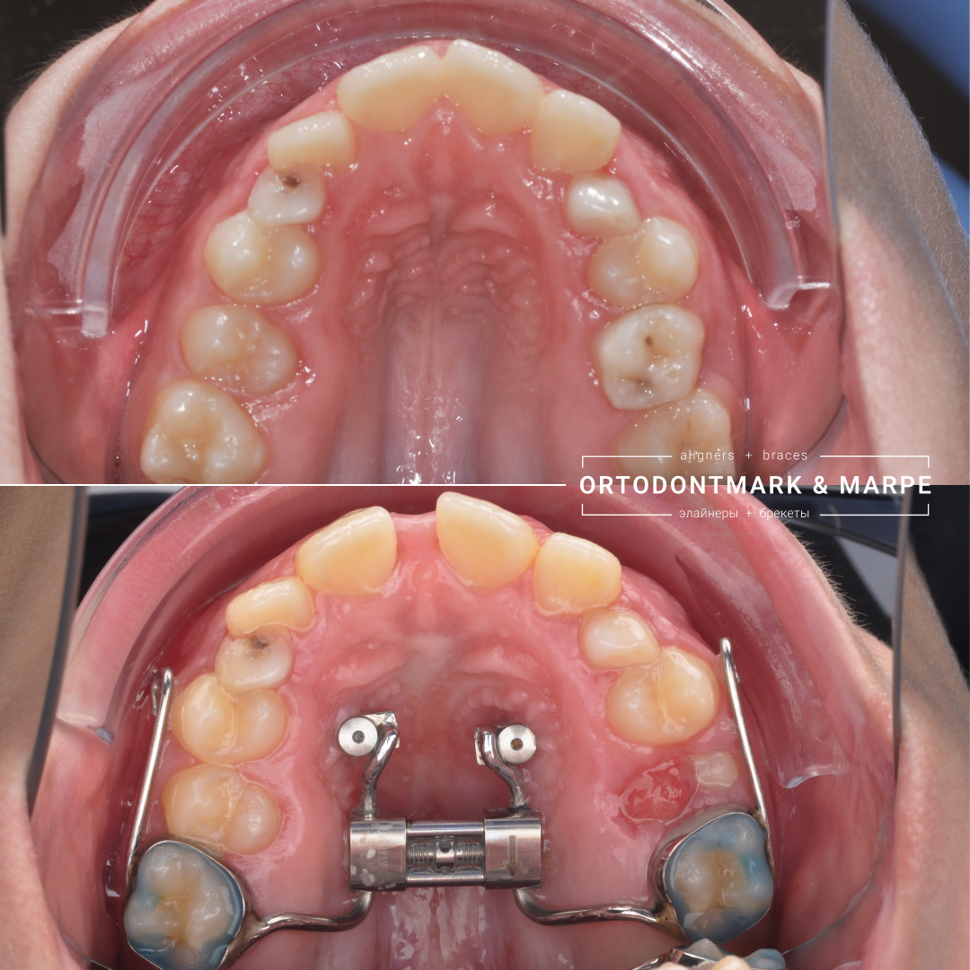 MARPE case result 17