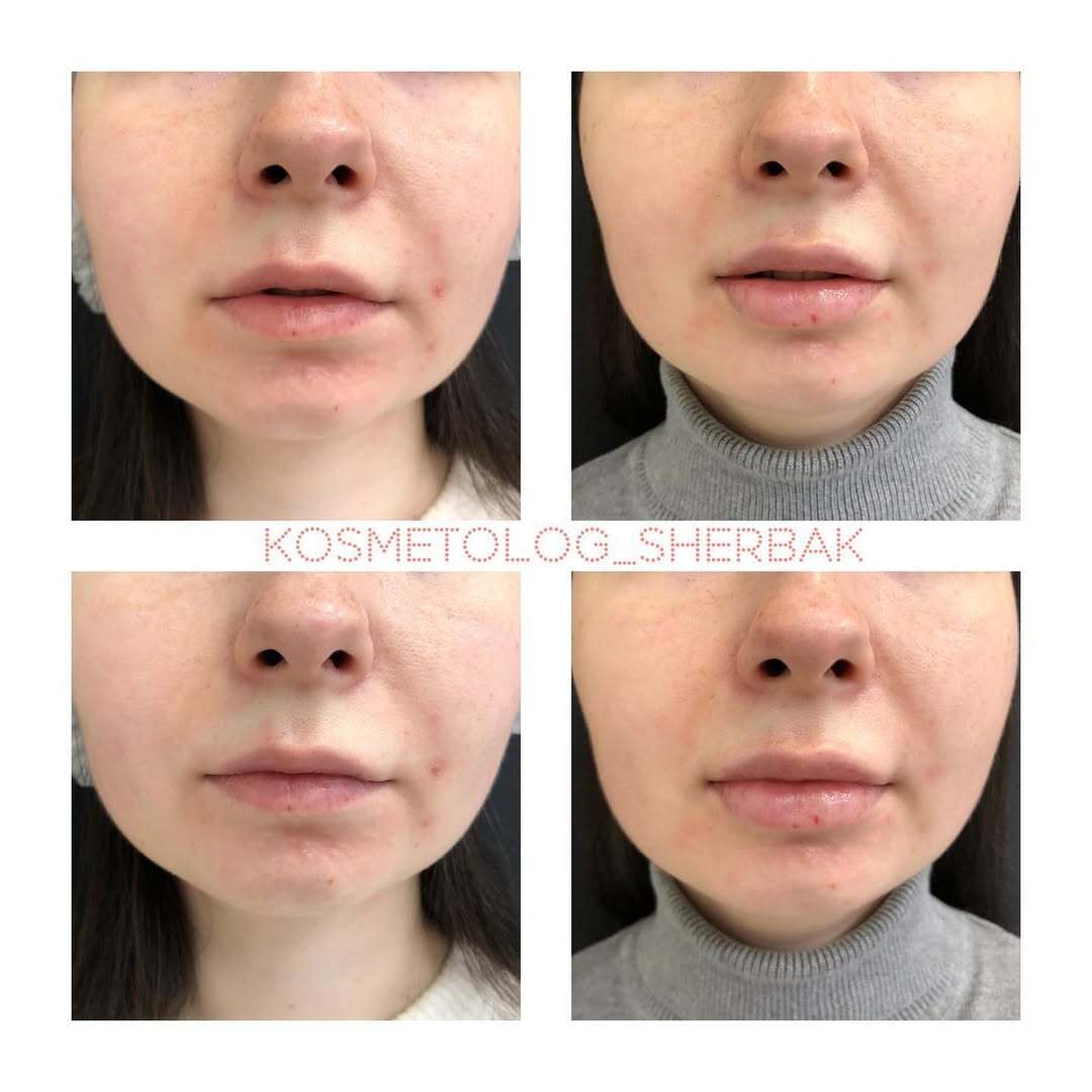 До и после контурной пластики губ. Увеличение объёма без утяжеления. PradusCOSMO, Васильевский остров