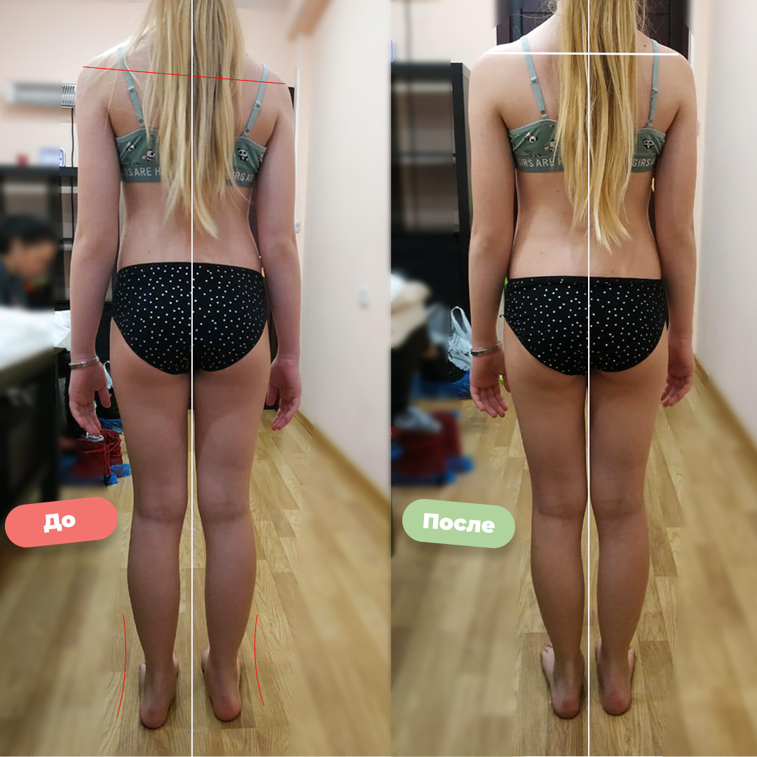 Вальгусная стопа и колено, перекос в плечах у девочки 10 лет