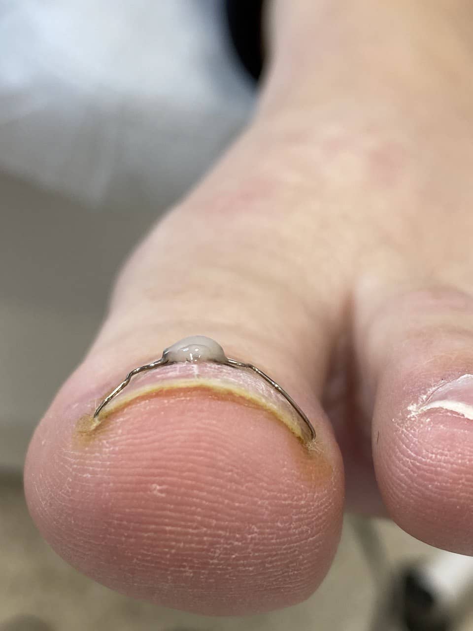 скоба +на ноготь москва, скобы +для ногтей +на ногах