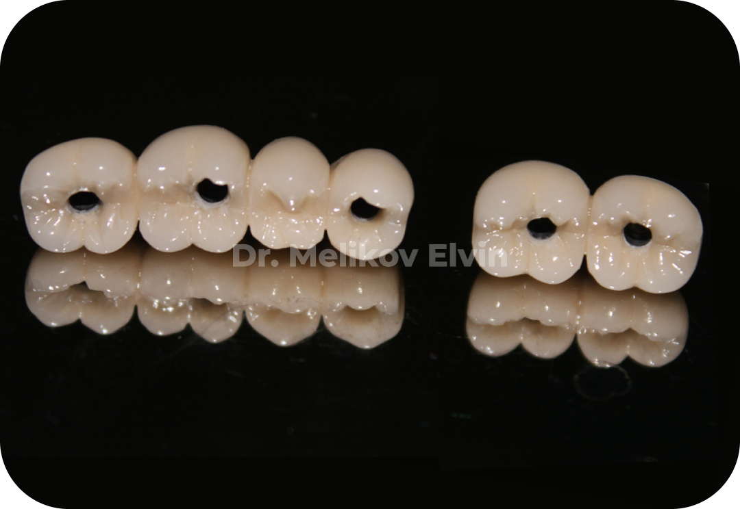 Ортопедические коронки на винтовой фиксации для нижней челюсти.