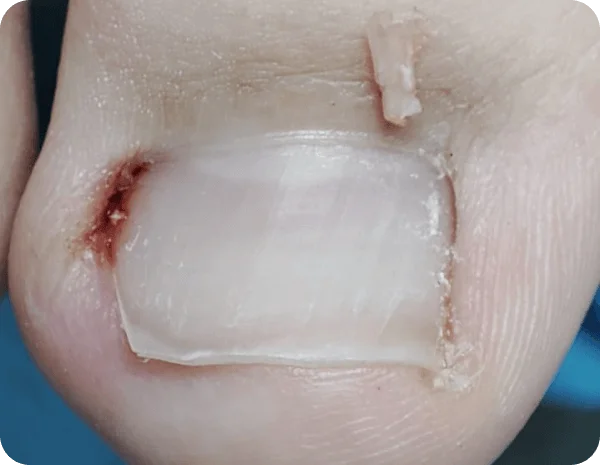 вросший ноготь на ноге, вросший ноготь, удаление вросшего ногтя, вросший ноготь лечение, вросший ноготь операция, удалить вросший ноготь, вросший ноготь цена