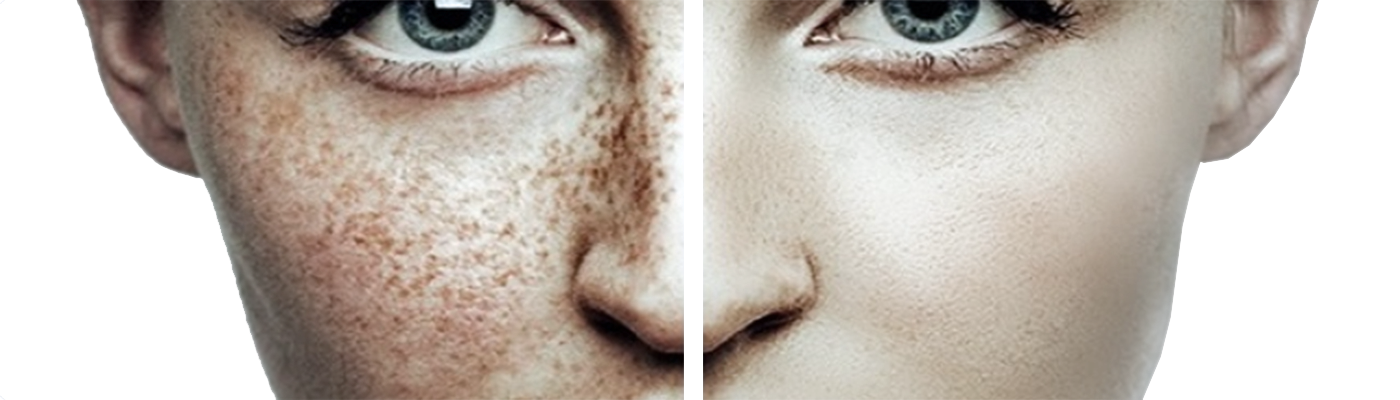 Pin by Lori Lorenz on sketch portrait reference photos in 2025 Women with freckles, Beautiful freckles, Freckles