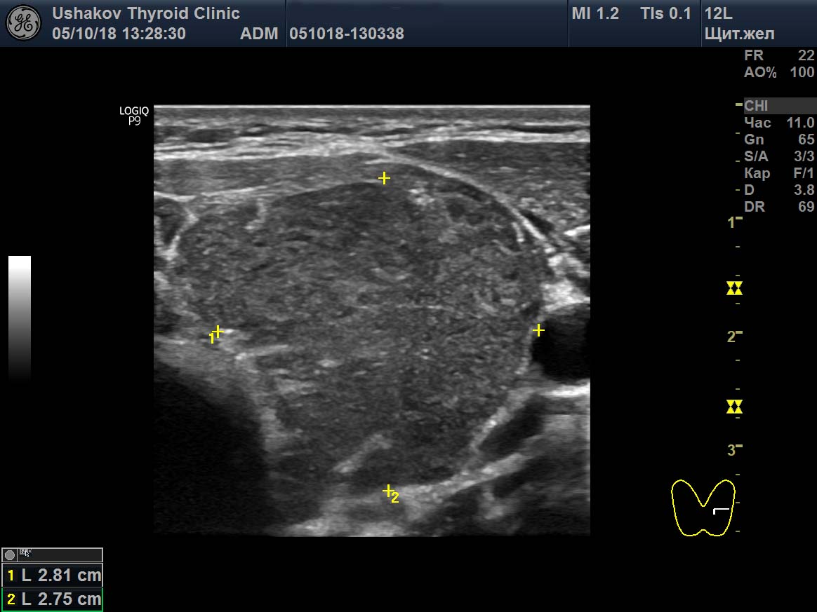 Узел гиперплазии щитовидной железы