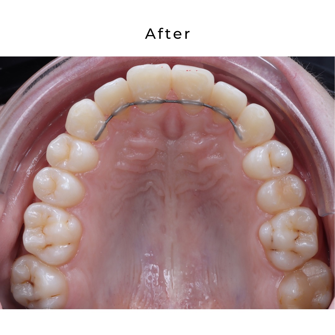 After treatment: aligned, expanded arches achieved with the Damon system — photo 6 of 6