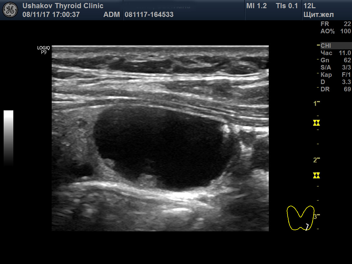 Как выглядит киста щитовидной железы на узи у женщин фото