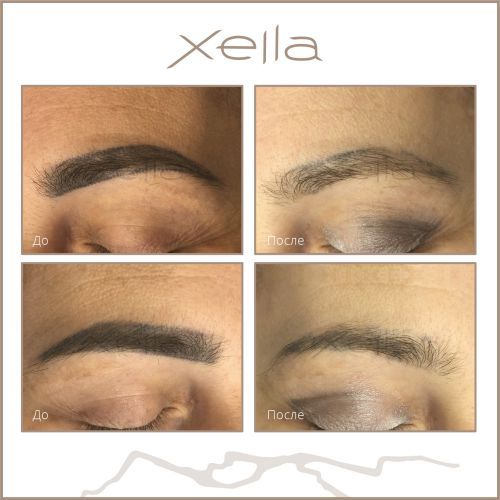 камуфляж шрамов перманентный. пикосекундный лазер для удаления татуировок. пикосекундный лазер neatcell. удаление пикосекундным лазером. пикосекундный лазер для удаления татуажа.