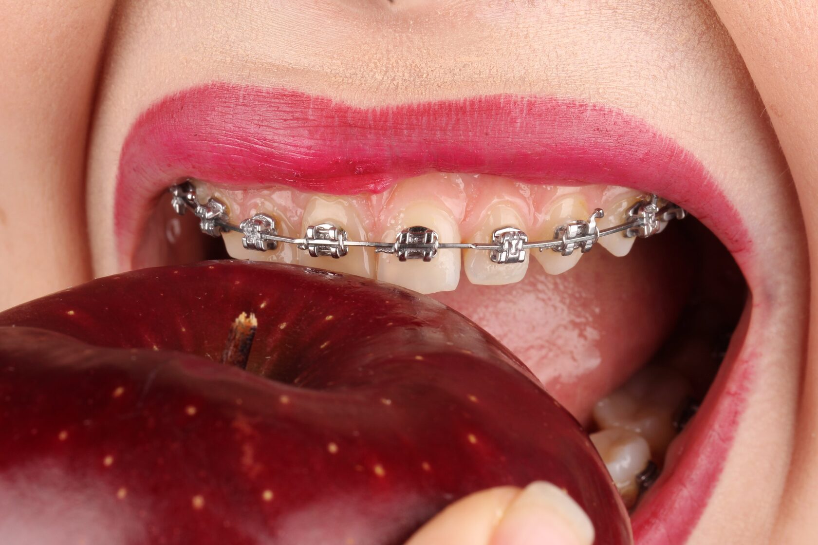 рекомендации по уходу за брекетами