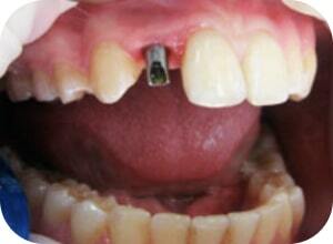 До имплантации