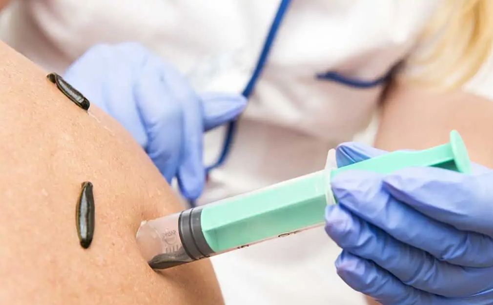 техника постановки пиявок