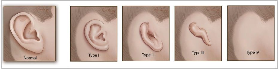 Ухо меньше другого. Микротия ушной раковины. Микротия анотия синдром. Микротия ушной раковины 4. Микротия наружного слухового прохода.