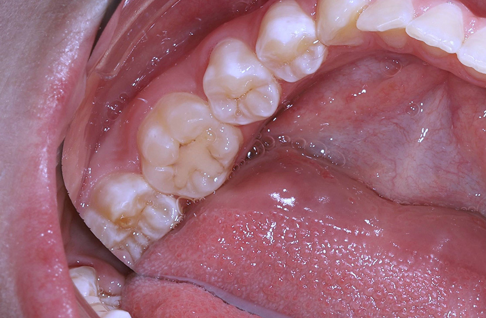 Замена негерметичной старой пломбы и лечение кариеса на соседнем зубе у подростка с жалобами на боль от сладкого