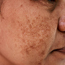 rf-лифтинг лица