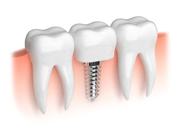 Сколько времени занимает имплантация зуба?