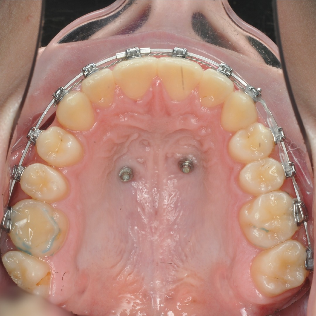 After result showing corrected space deficit achieved without tooth extraction — photo 5 of 5
