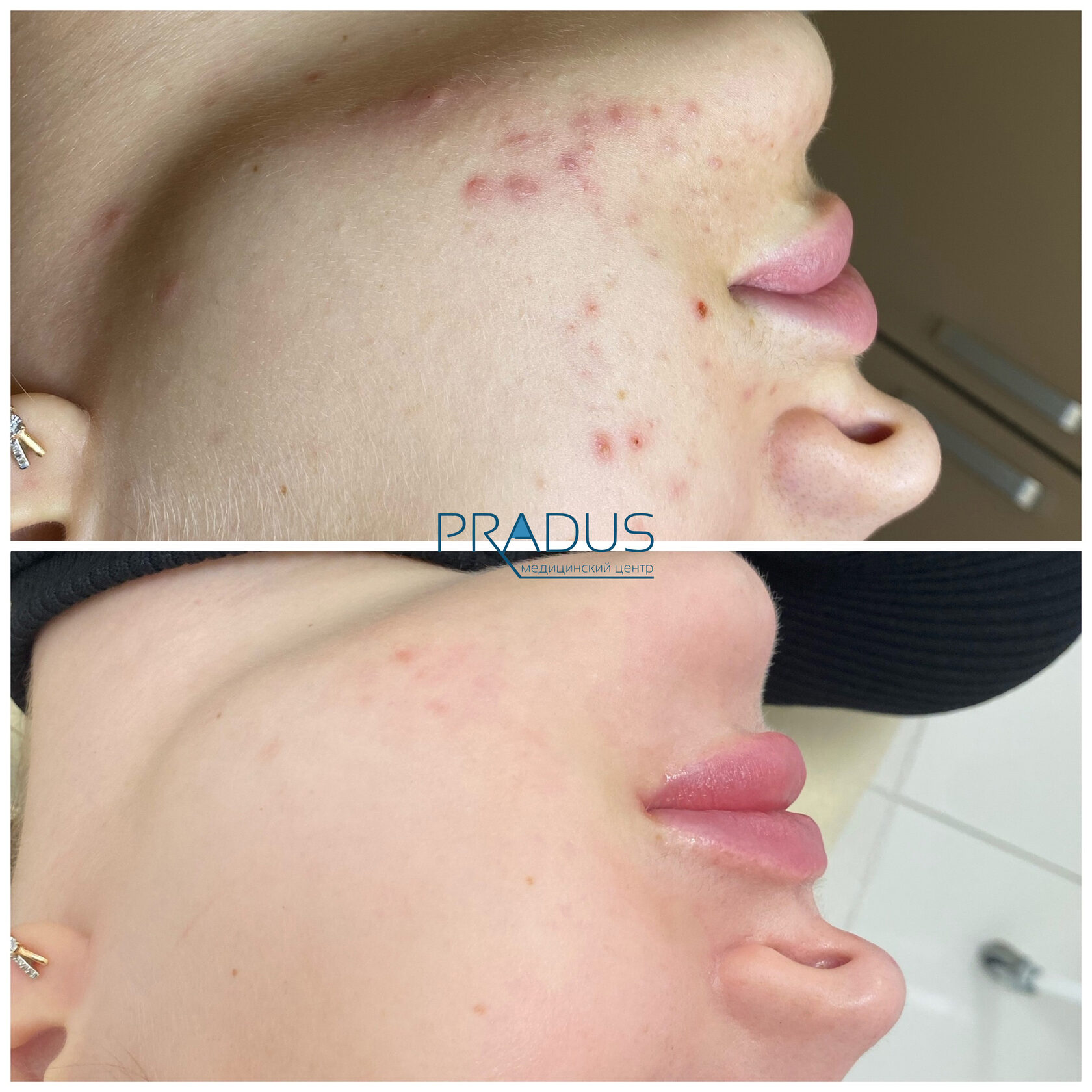 Лечение акне у женщины в клинике PradusCOSMO, СПб. До и после процедуры