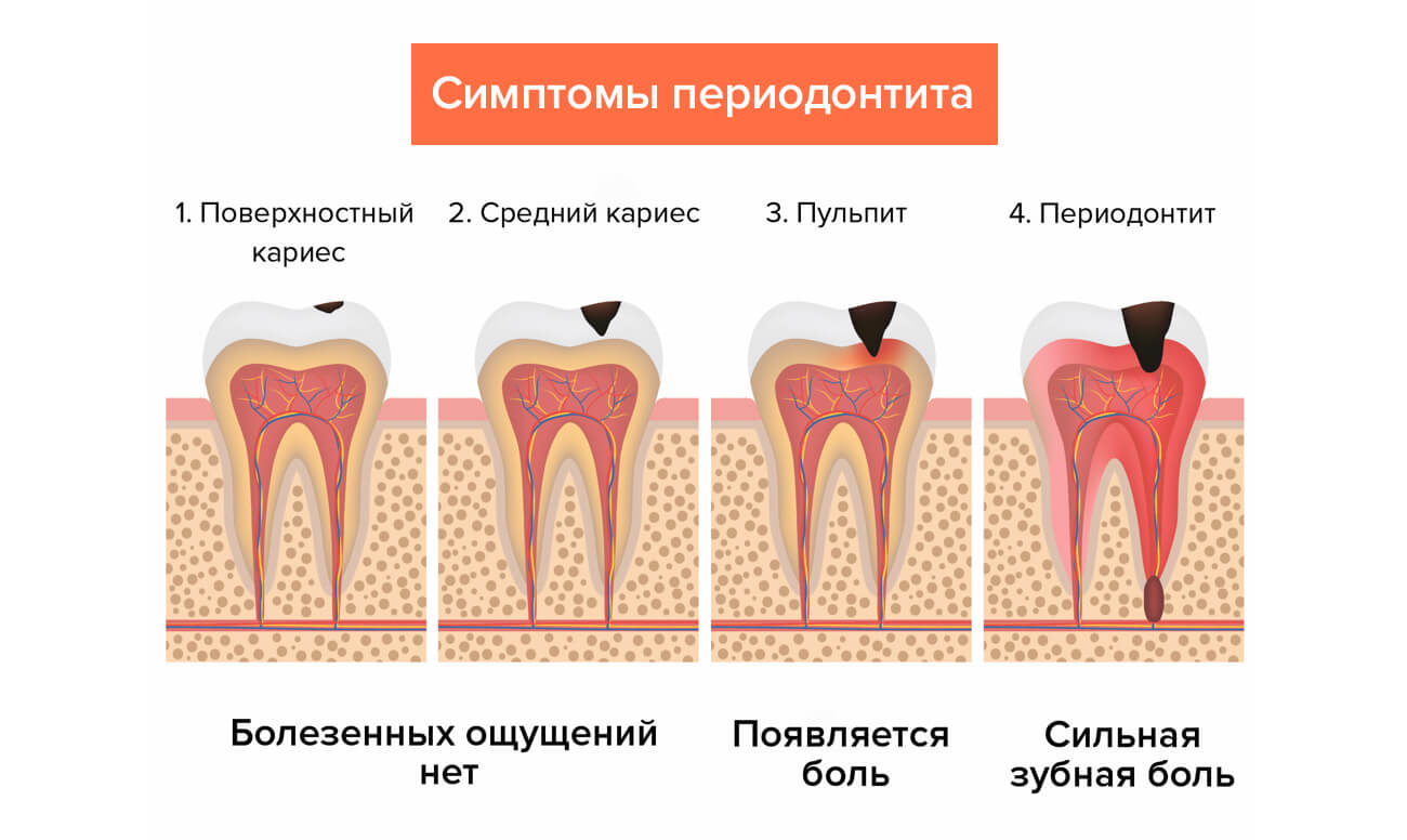 Болезни зубов картинки