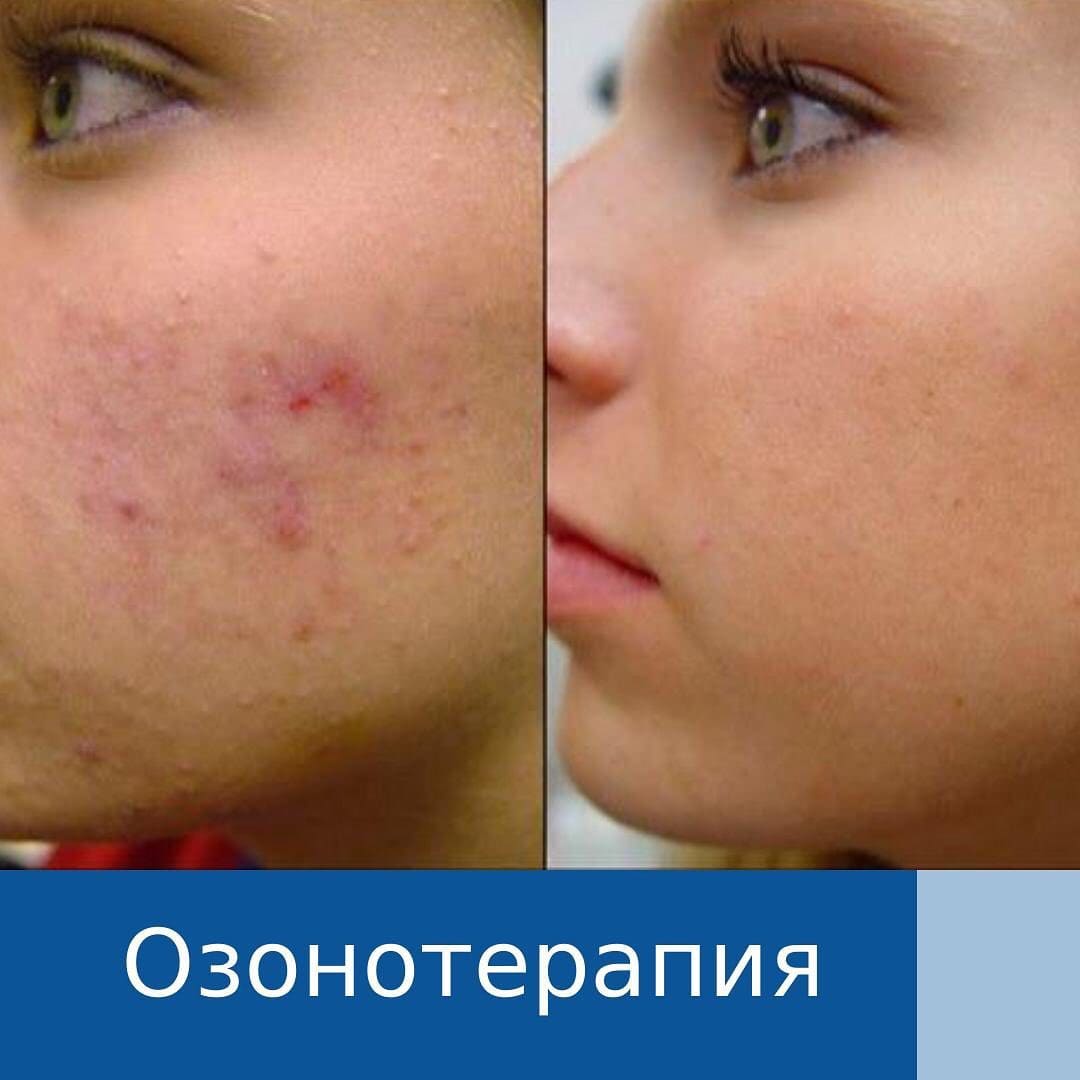 Высыпания На Лице После Куни Высыпания На Лице После Куни