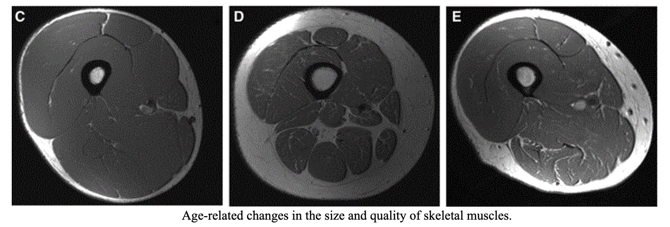 MRI, muscle tissue, muscle mass, sarcopenia, basal metabolic rate, weakness 