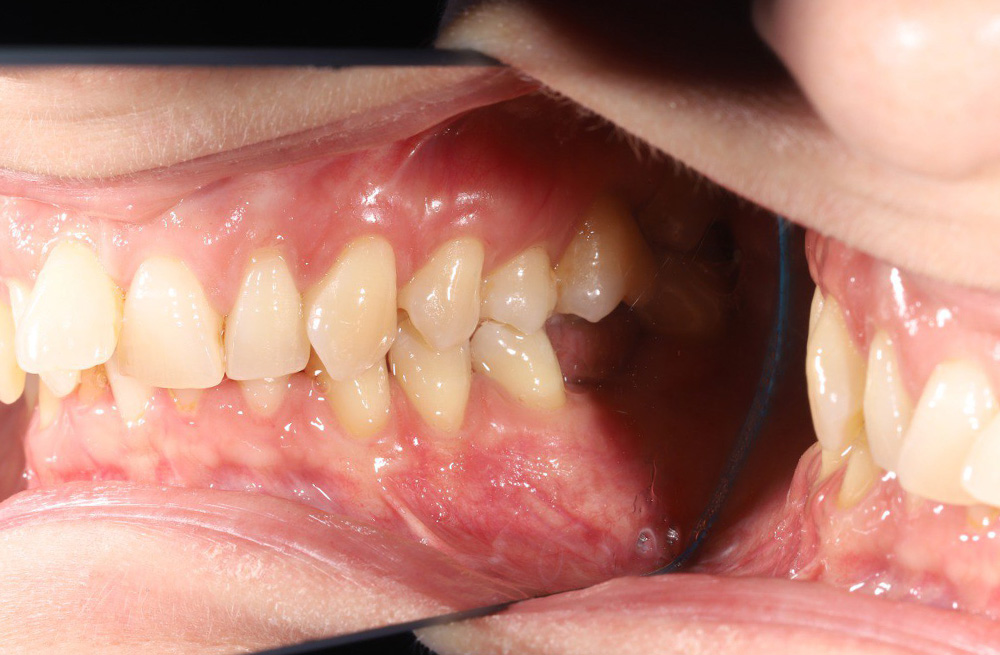 Установка импланта в область удалённого зуба завершённая коронкой на винтовой фиксации