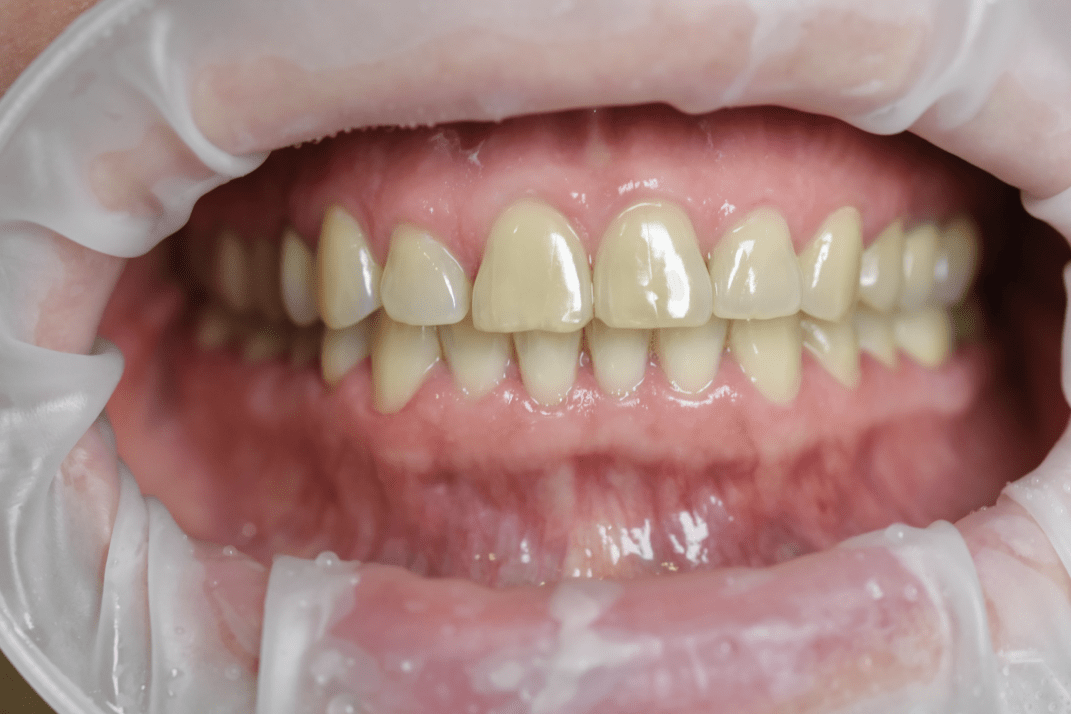 Чистка зубов - Москва - Мичуринский проспект - стоматология