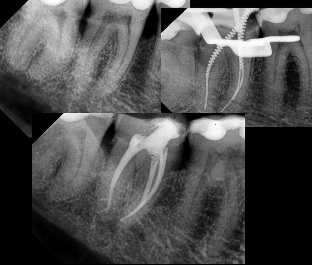 Рентгенологическая верхушка корня зуба